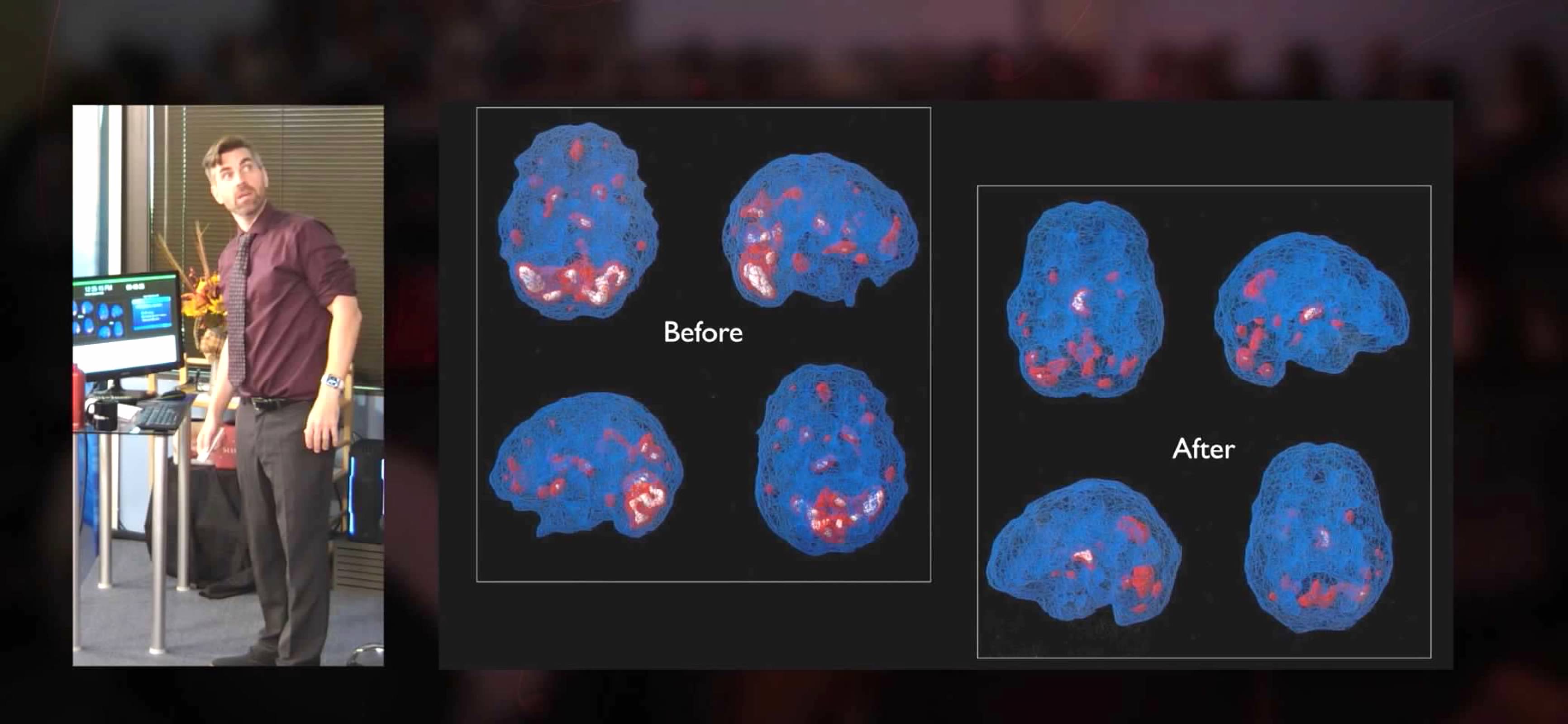 Brain scan Before and After neurofeedback